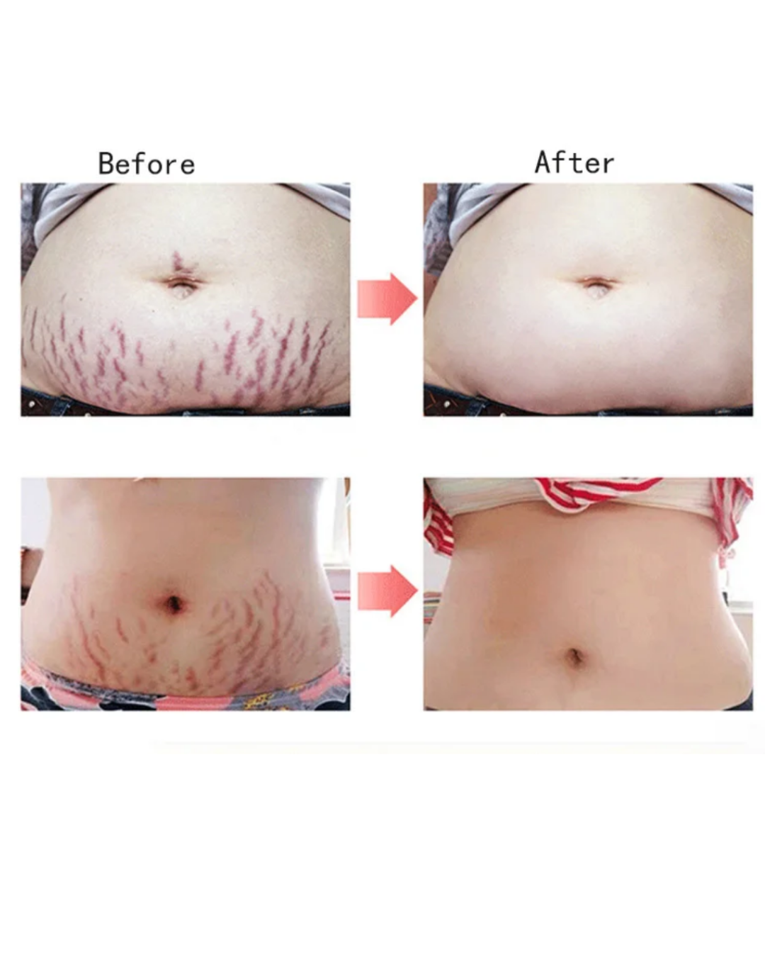 Créme cicatrice, vergetures,cheloïdes, boutons , taches pour hommes, femmes et enfants Resultat en moyenne 7jrs