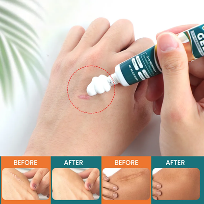 Créme cicatrice, vergetures,cheloïdes, boutons , taches pour hommes, femmes et enfants Resultat en moyenne 7jrs