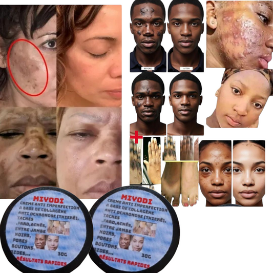 Créme miracle anti imperfections Miyodi (boutons,ride,mami , hyperpigmentation,melasma,entre jambes noirs,fard,acnés,pores dilatés, rougeurs Resultat visible en 7j)tout type de peaux et teint 30g pour homme et femmes