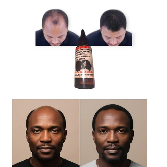 HUILE MIRACLE MIYODI CHEVEUX BARBE, CALVITIE ET ALOPÉCIE POUR HOMMES FEMMES ET ENFANTS
