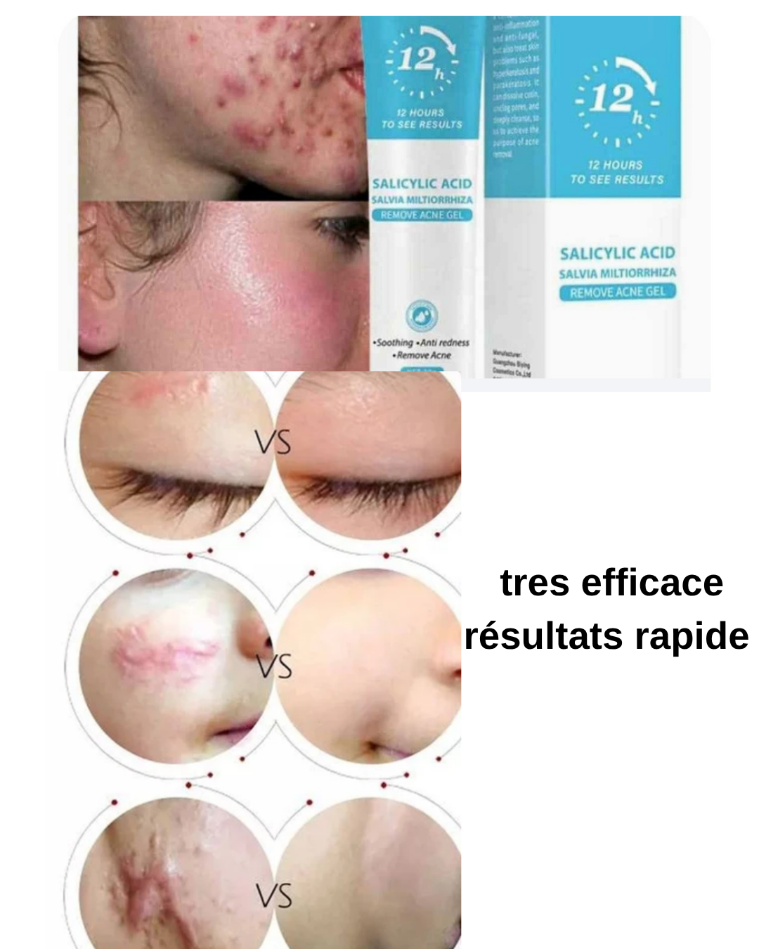 Créme cicatrice, vergetures,cheloïdes, boutons , taches pour hommes, femmes et enfants Resultat en moyenne 7jrs