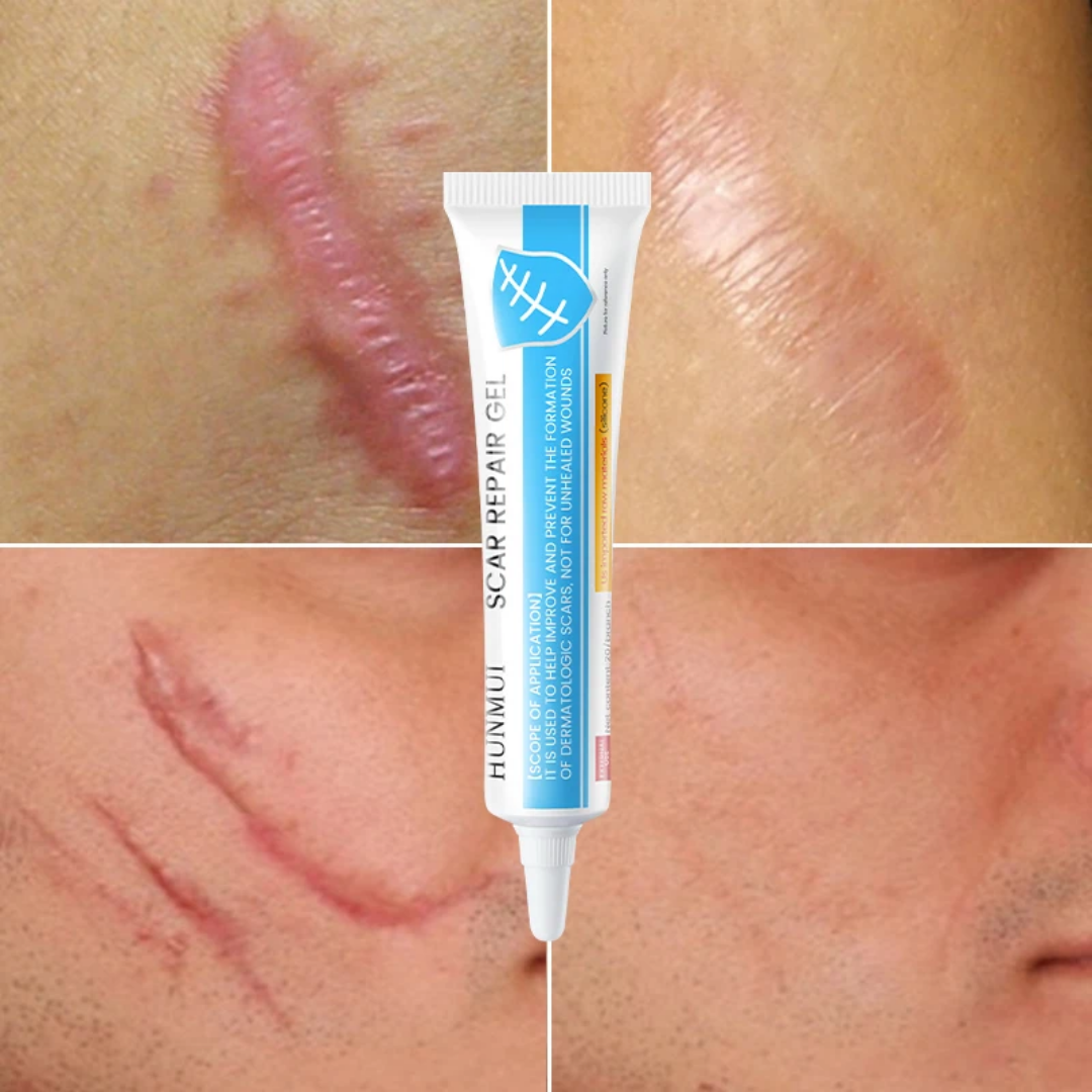 Créme cicatrice, vergetures,cheloïdes, boutons , taches pour hommes, femmes et enfants Resultat en moyenne 7jrs