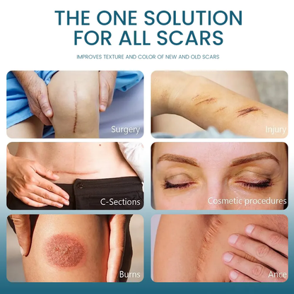 Créme cicatrice, vergetures,cheloïdes, boutons , taches pour hommes, femmes et enfants Resultat en moyenne 7jrs
