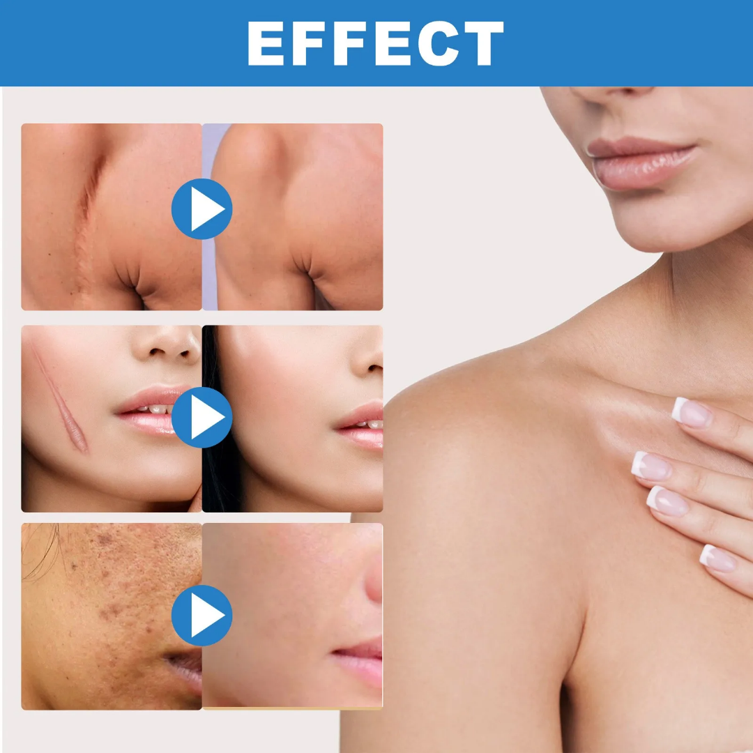 Créme cicatrice, vergetures,cheloïdes, boutons , taches pour hommes, femmes et enfants Resultat en moyenne 7jrs