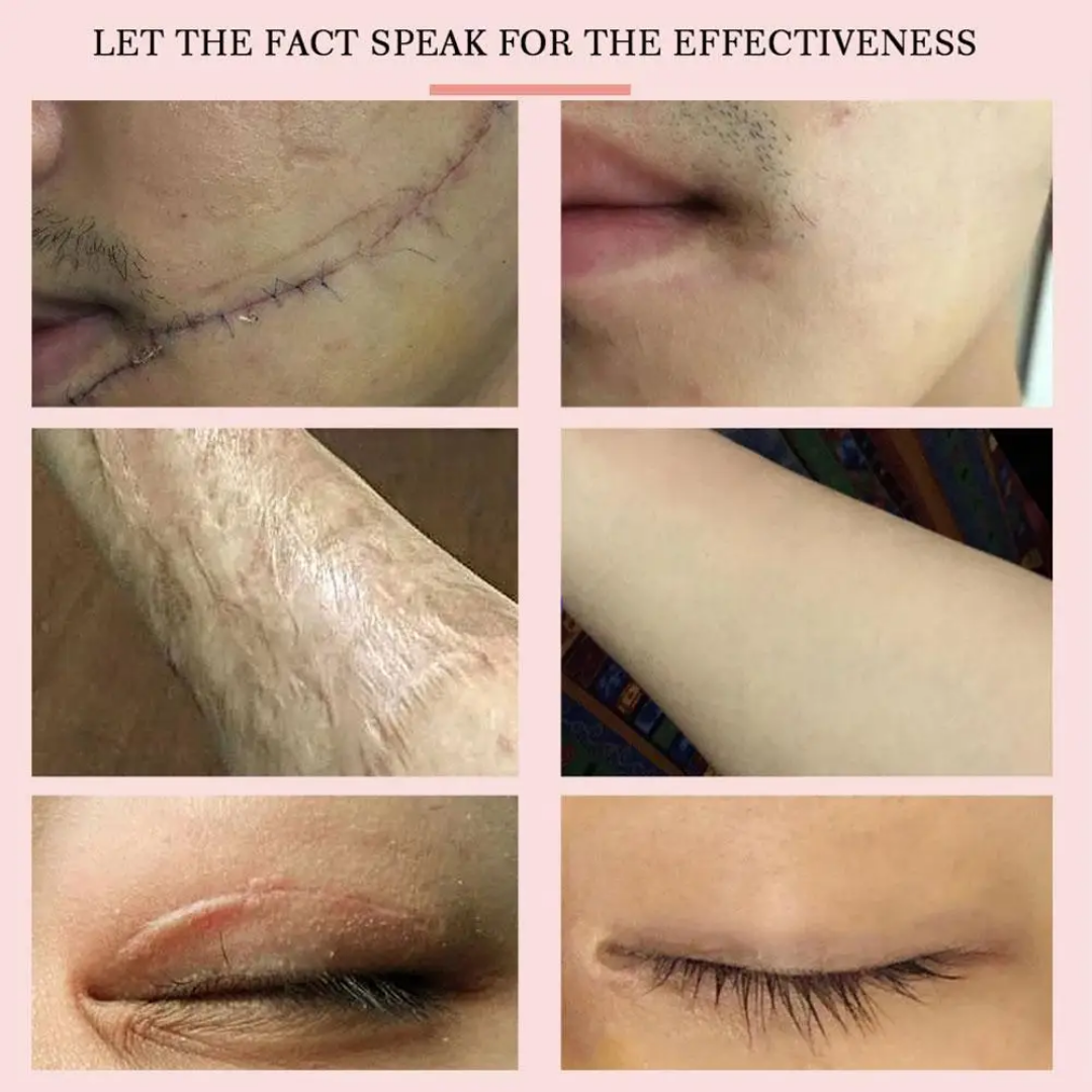 Créme cicatrice, vergetures,cheloïdes, boutons , taches pour hommes, femmes et enfants Resultat en moyenne 7jrs