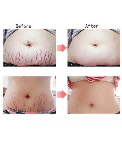 Créme cicatrice, vergetures,cheloïdes, boutons , taches pour hommes, femmes et enfants Resultat en moyenne 7jrs