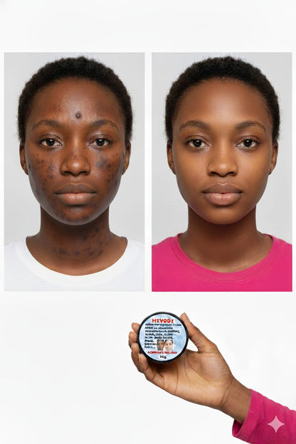 Créme miracle anti imperfections Miyodi (boutons,ride,mami , hyperpigmentation,melasma,entre jambes noirs,fard,acnés,pores dilatés, rougeurs Resultat visible en 7j)tout type de peaux et teint 30g pour homme et femmes