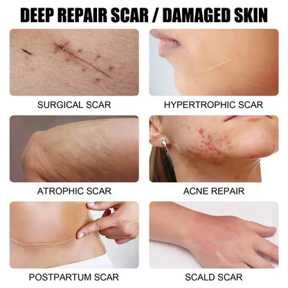 Créme cicatrice, vergetures,cheloïdes, boutons , taches pour hommes, femmes et enfants Resultat en moyenne 7jrs